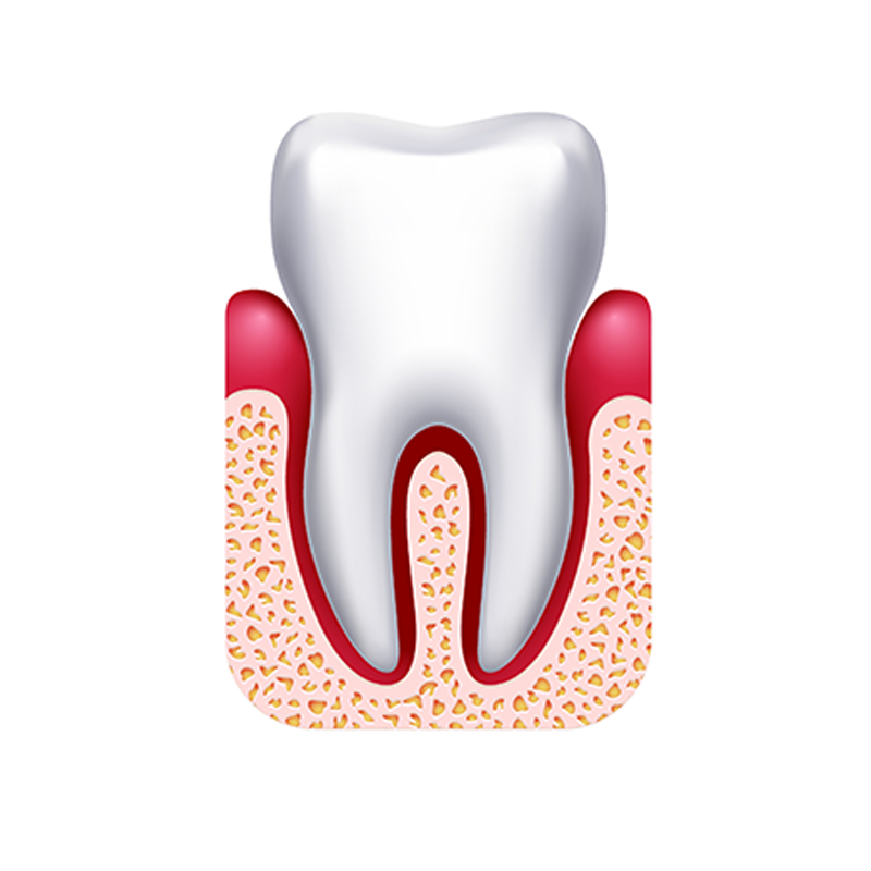3D illustration of a tooth with gingivitis.